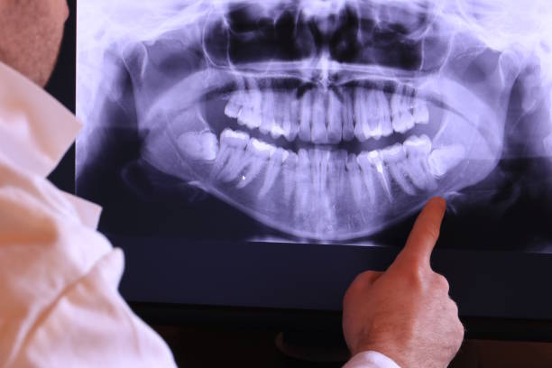 Best Emergency Wisdom Teeth Removal in West Jefferson, NC